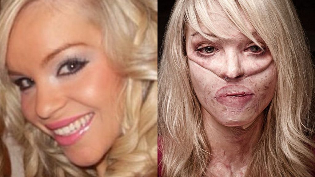 Katie Piper was doused with acid 13 years ago on the orders of her ex-boyfriend.  More than 400 plastic surgeries.  This is what it looks like now