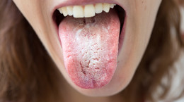 Mycosis of the tongue - the most common causes and characteristic symptoms.  What is the treatment for tinea pedis? [WYJAŚNIAMY]