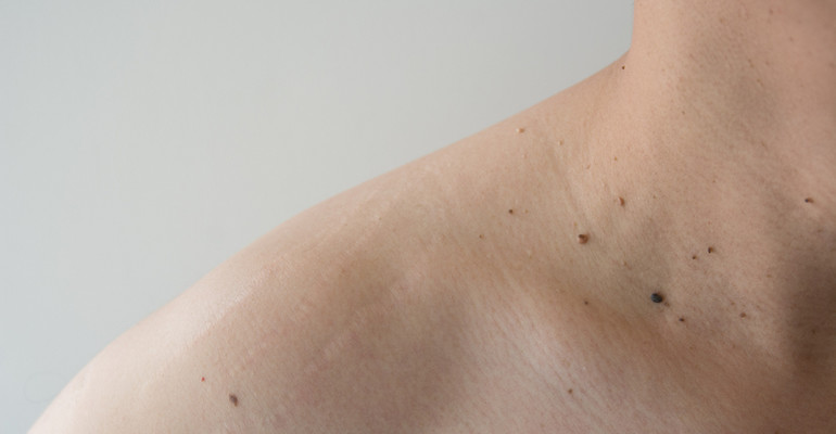 Do skin lesions go away after the COVID-19 vaccination?
