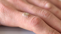 Effective products to fight warts