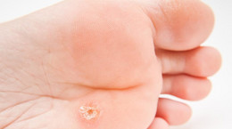 What are warts?  Types and treatment of warts