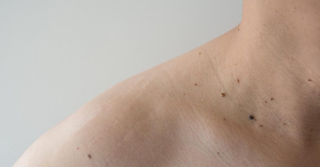 Warts, moles, and birthmarks may disappear after the COVID-19 vaccine