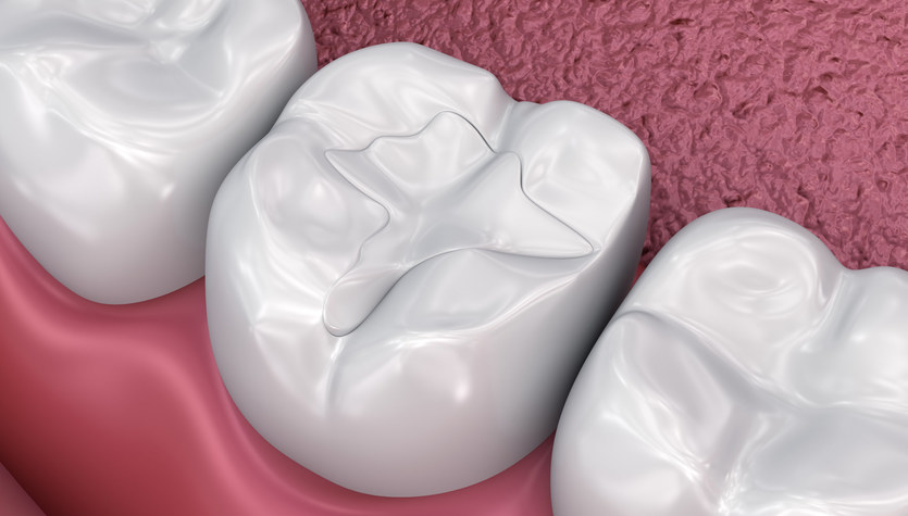 A revolution in dentistry is coming.  Synthetic enamel was created