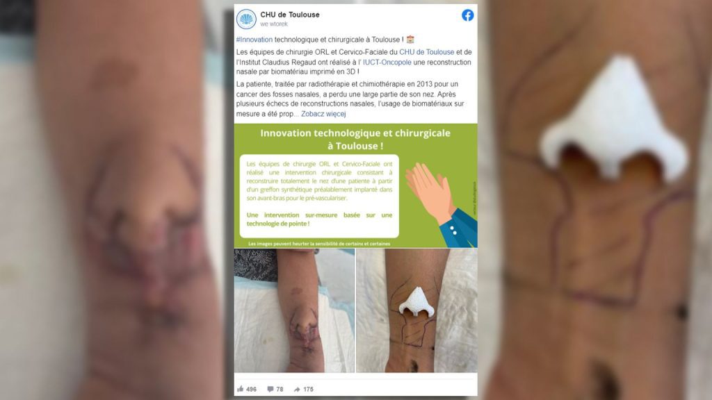 France.  The woman lost part of her nose to cancer.  A new one "slept" on her forearm |  world News